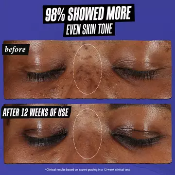 before & after on dark skin: 98% showed more even skin tone 