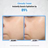 ultra-pure-high-potency-serum-hyaluronic-acid-before-after
