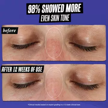 before & after on light skin: 98% showed more even skin tone 