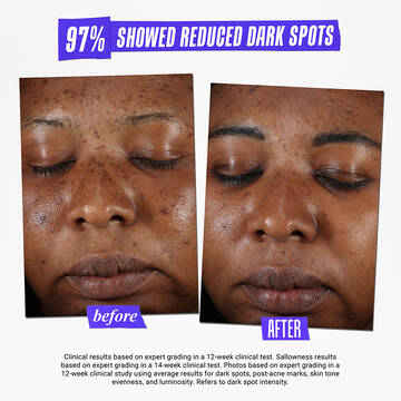 97% showed reduced dark spots. before and after comparison