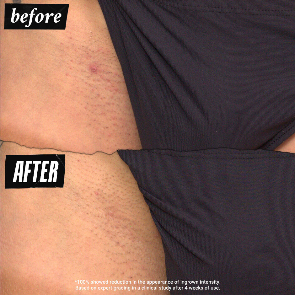 Ingrown Hair & Tone-Correcting Intimate Drops - Treatments - Kiehl's