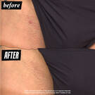 Ingrown Hair and Tone-Correcting Intimate Drops