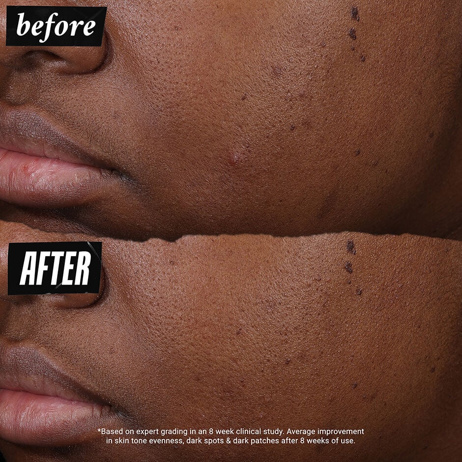 Before and after image on dark skin tone *based on expert grading in an 8 week clinical study. Average improvement in skin tone evenness, dark spots & dark patches afrer 8 weeks of use.