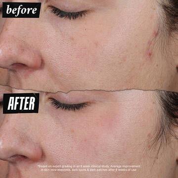 Before and after image on light skin tone *based on expert grading in an 8 week clinical study. Average improvement in skin tone evenness, dark spots & dark patches afrer 8 weeks of use.