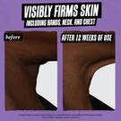 before & after of neck: visibly firms skin including hands, neck and chest after 12 weeks of use