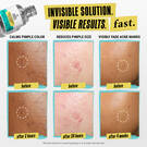 Truly Targeted Acne-Clearing Pimple Patch with Salicylic Acid