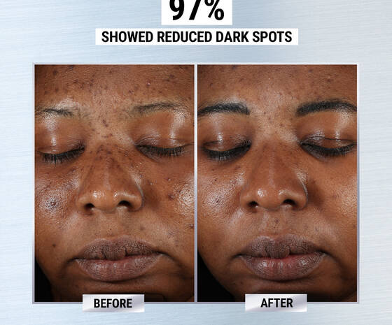 Clearly Corrective Dark Spot Solution Dark Spot Corrector Kiehl S Clearly Corrective Dark Spot Solution Dark Spot Corrector Kiehl S