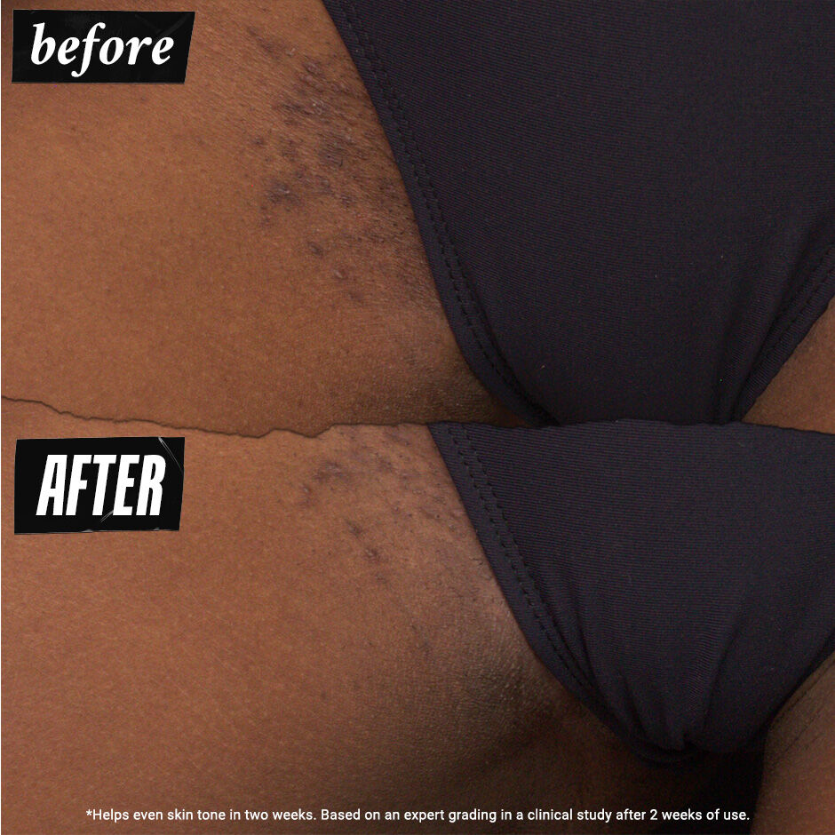 Ingrown Hair and Tone-Correcting Intimate Drops