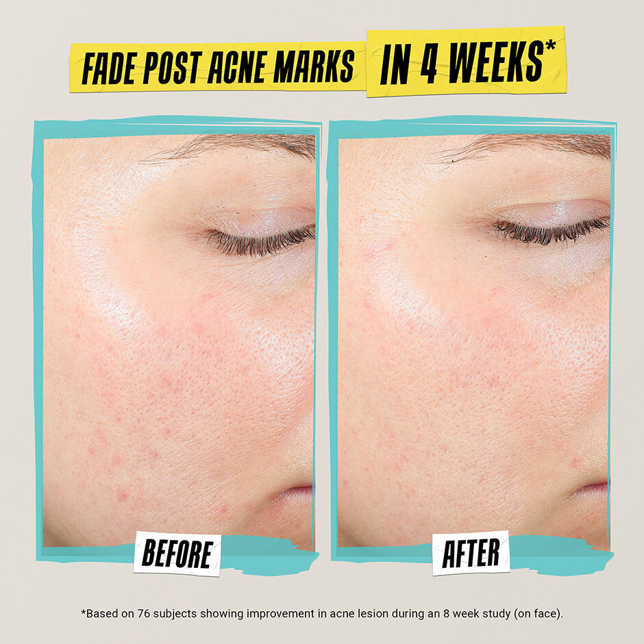 Moisturizer for Acne Prone Skin with Salicylic Acid Kiehl s