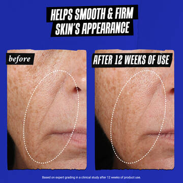 before & after of Nasolabial folds: Helps smooth & firm shin's appearance 