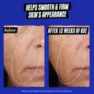 before & after of Nasolabial folds: Helps smooth & firm shin's appearance 
