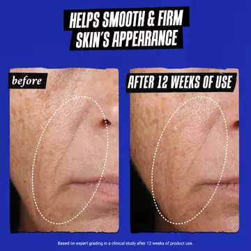 before & after of Nasolabial folds: Helps smooth & firm shin's appearance 