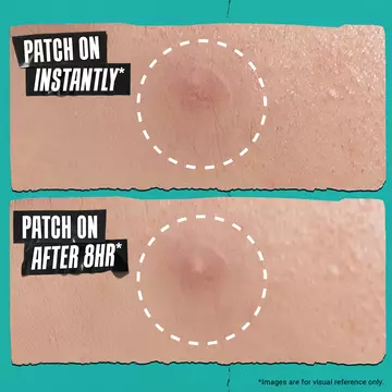 Truly Targeted Overnight Blemish Patch