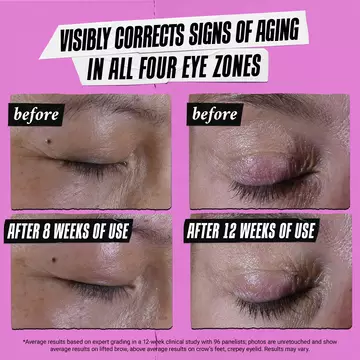 Visibly corrects signs of aging in all four eye zones. before and after of eye lids shown 
