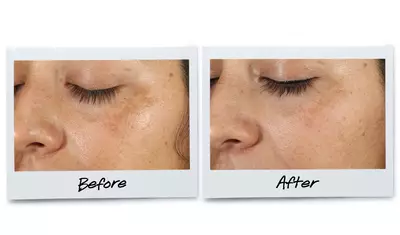 Before and after