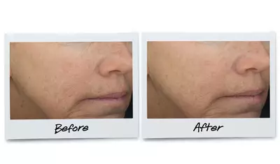 Before and after