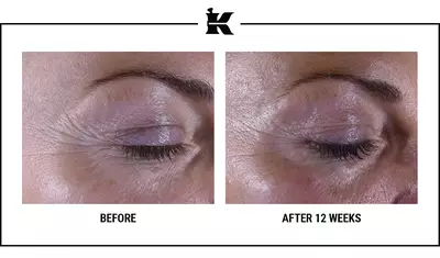 Before and After Super Multi-Corrective Eye Zone Treatment