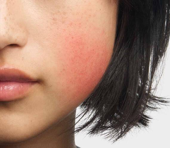 Woman's cheek displaying facial redness and flushing typical of rosacea symptoms