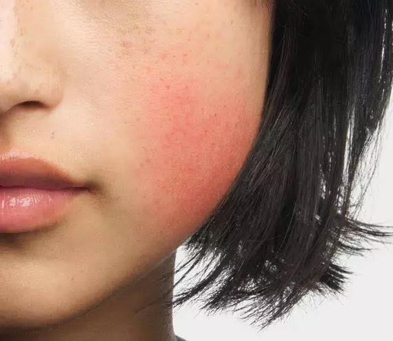 Woman's cheek displaying facial redness and flushing typical of rosacea symptoms