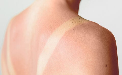 How To Prevent and Calm Sunburns